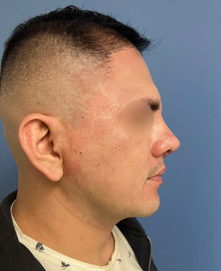 Resultado de rinoplastia ultrasónica antes y después en Lima
