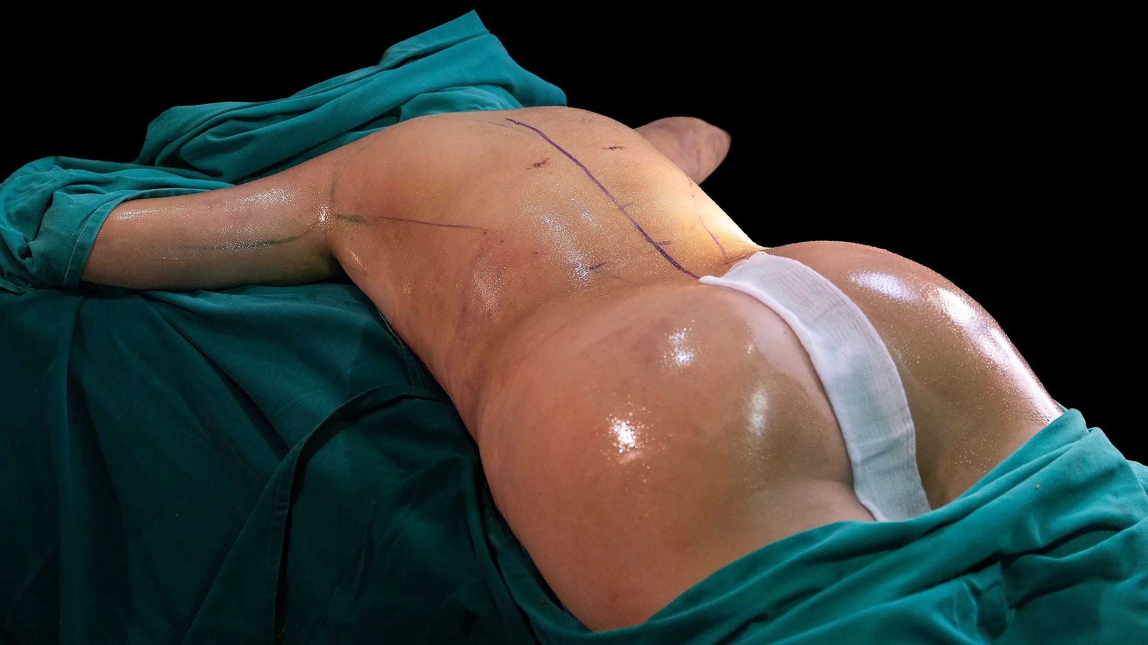 Dermolipectomía y contorno corporal en Lima